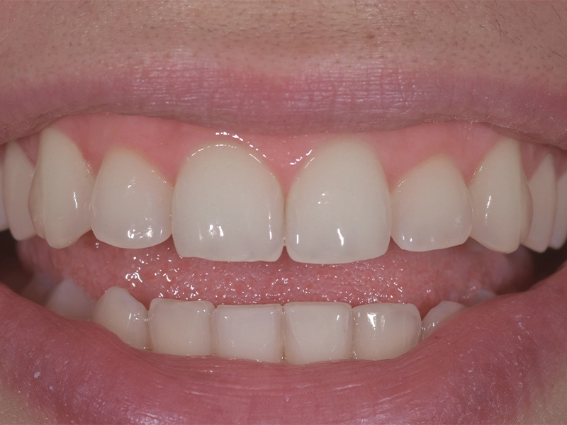 After teeth whitening, example 1