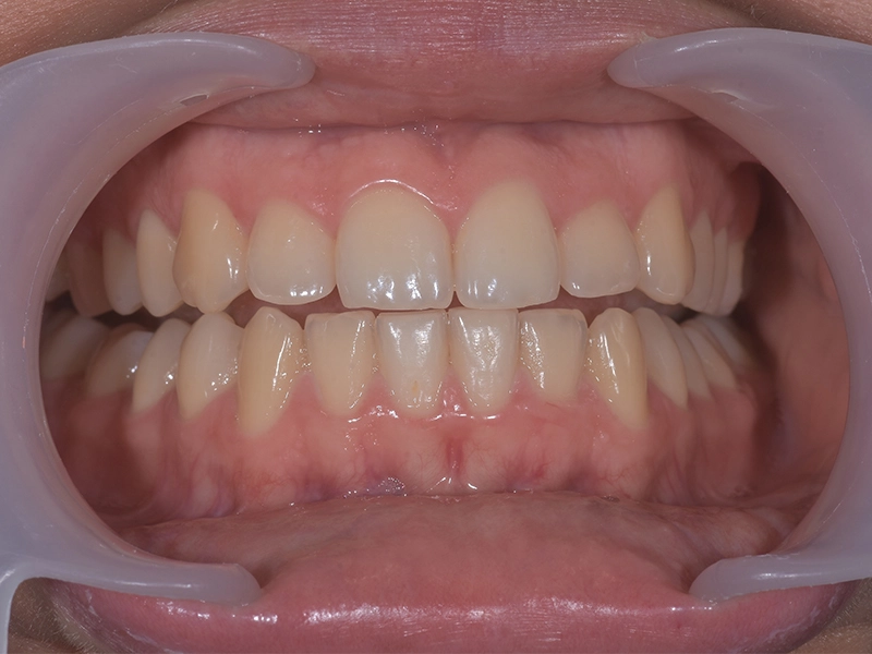 Before teeth whitening, example 1