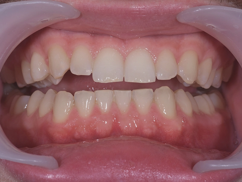 After teeth whitening, example 2