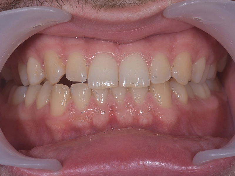 Before teeth whitening, example 2